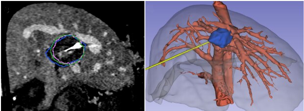CT slice of a liver and vascular tree with the needle