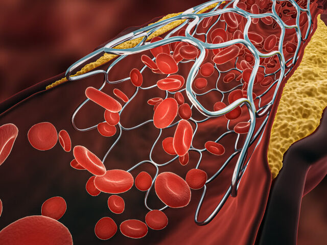 Stent déployé dans une artère sténosée